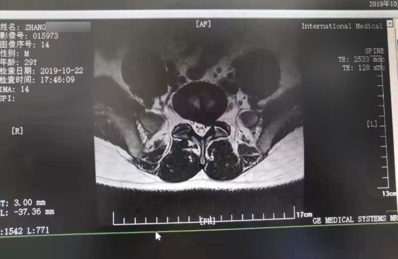 三秦網(wǎng)報道—西安國際醫(yī)學中心骨科醫(yī)院成功完成首例椎間孔鏡手術(shù)