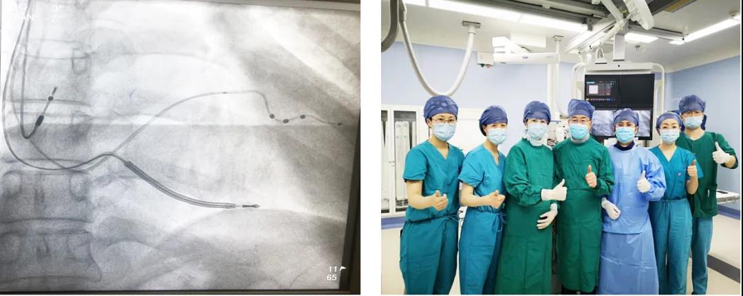 西安國際醫(yī)學中心醫(yī)院心臟內(nèi)科首例心臟再同步治療除顫器（CRT-D）植入成功