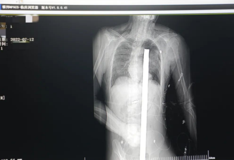 1.2米長的鋼筋貫穿男子胸腹！情況極度危險......