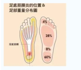 每年新生數(shù)百萬足底筋膜炎患者！國際醫(yī)學(xué)專家提醒：跑步要選擇合適的鞋