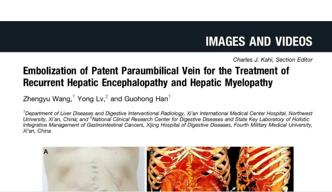 我院護(hù)理團(tuán)隊(duì)臨床成果登榜國(guó)際肝病權(quán)威期刊，影響因子11.6